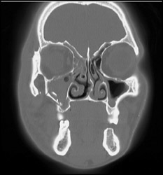 Orbital Fractures - CTisus CT Scan