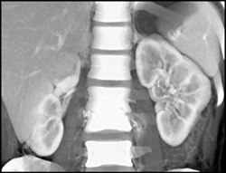 Osteomyelitis With Psoas Abscess - CTisus CT Scan