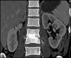 Infected Disc Space - CTisus CT Scan