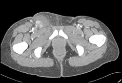 Bleed in Groin - CTisus CT Scan