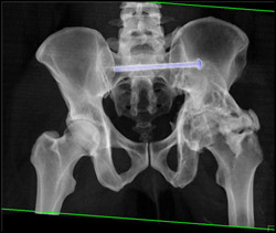 Pinning for Repair of SI Joint Injury - CTisus CT Scan