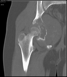 Ewing Sarcoma - CTisus CT Scan