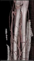 Normal Vessels - CTisus CT Scan