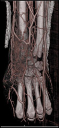 Cellulitis - CTisus CT Scan