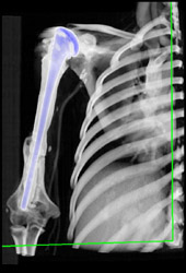 Surgery From Osteosarcoma - CTisus CT Scan