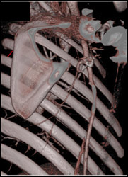 Normal Axillary Artery Post Op - CTisus CT Scan