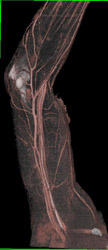 Abscess Forearm With Angiogram - CTisus CT Scan