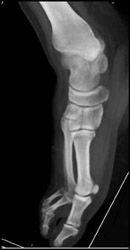 Fracture Medial Cuniform - CTisus CT Scan