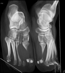 Medial Cuniform Fracture - CTisus CT Scan