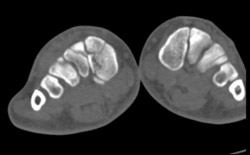 High Resolution of Tarsal Fractures - CTisus CT Scan