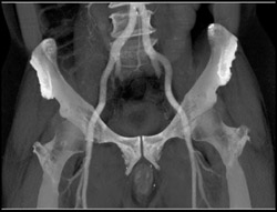 CTA in Pelvic Trauma - CTisus CT Scan