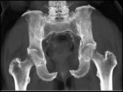 Acetabular Fractures - CTisus CT Scan