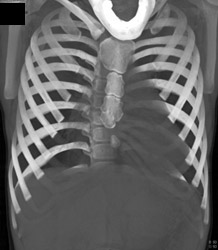 Pectus Deformity - CTisus CT Scan