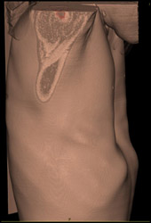 Pectus Deformity - CTisus CT Scan