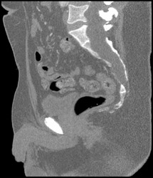 Dural Ectasia- Marfan - CTisus CT Scan