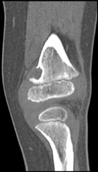 Benign Fibrous Defects - CTisus CT Scan