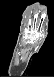 Cellulitis - CTisus CT Scan