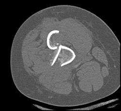 Femur Fracture With Bleed - CTisus CT Scan