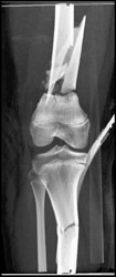 Tibial, Fibular, and Femoral Fractures - CTisus CT Scan