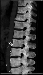 Blastic Metastases - CTisus CT Scan