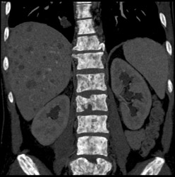 Carcinoid Metastases - CTisus CT Scan