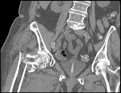 Femur Fracture - CTisus CT Scan