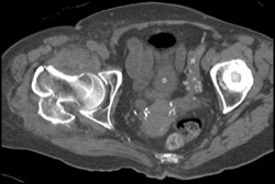 Femur Fracture - CTisus CT Scan