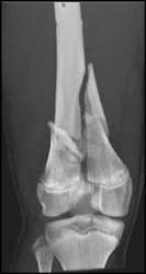 Femur Fracture - CTisus CT Scan