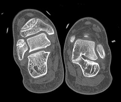 Tarsal Coalition - CTisus CT Scan