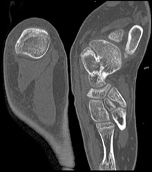 Tarsal Coalition - CTisus CT Scan