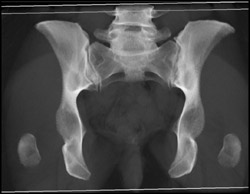 Infection of Left SI Joint - CTisus CT Scan