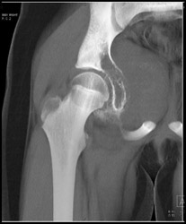 Ewing Sarcoma - CTisus CT Scan