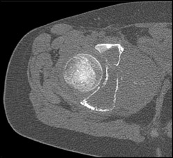 Ewing Sarcoma - CTisus CT Scan