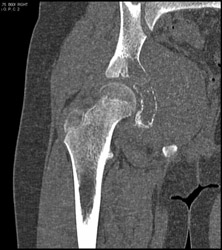 Ewing Sarcoma - CTisus CT Scan