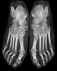 Tarsal Coalition - CTisus CT Scan