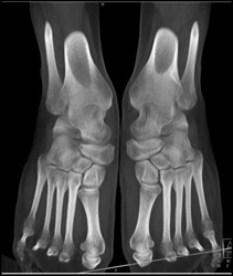 Tarsal Coalition - CTisus CT Scan