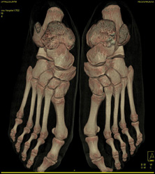 3D of the Foot - CTisus CT Scan