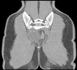 Destructive Sacral Lesion - CTisus CT Scan