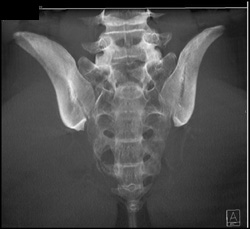 Chordoma - CTisus CT Scan