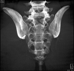 Chordoma - CTisus CT Scan