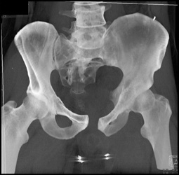 Fracture-dislocation - CTisus CT Scan