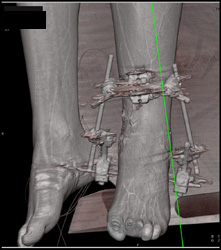 Open Reduction Internal Fixation (ORIF) for Fracture - CTisus CT Scan