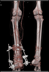 Open Reduction Internal Fixation (ORIF) With CTA - CTisus CT Scan