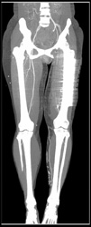 CTA of the Lower Extremities - CTisus CT Scan