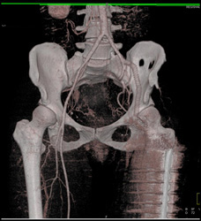 Occluded Left Iliac Artery With Graft - CTisus CT Scan