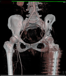 Occluded Left Iliac Artery - CTisus CT Scan