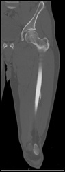 Stress Fracture - CTisus CT Scan