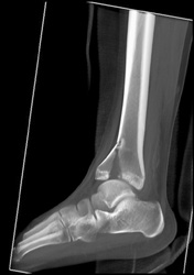 Tibial/fibular Fractures - CTisus CT Scan