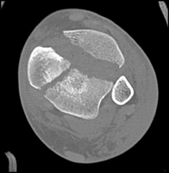 Comminuted Tibial Fracture - CTisus CT Scan