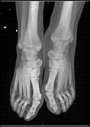 Intact Ankle With Normal Tarsal Bones - CTisus CT Scan